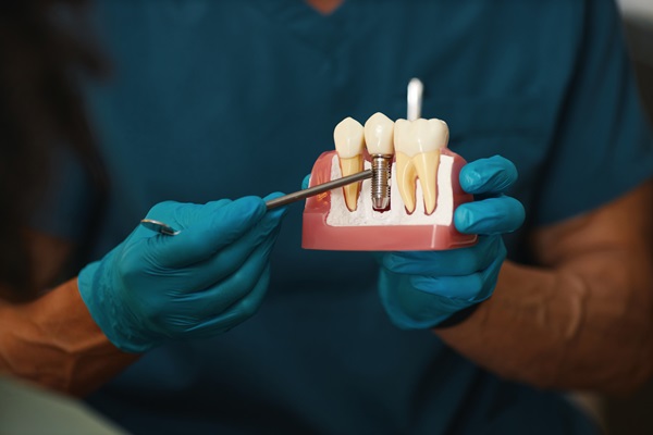 Simple Steps To Place Dental Implants